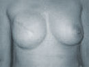 Implanted breast expander