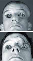 Skin harvesting