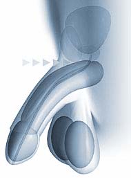 chirurgie de îndreptare a penisului în timpul actului sexual  erecția dispare din motive