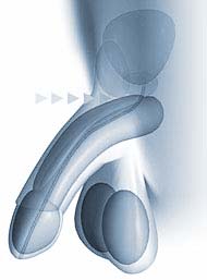 îndreptarea de către un extensor al penisului